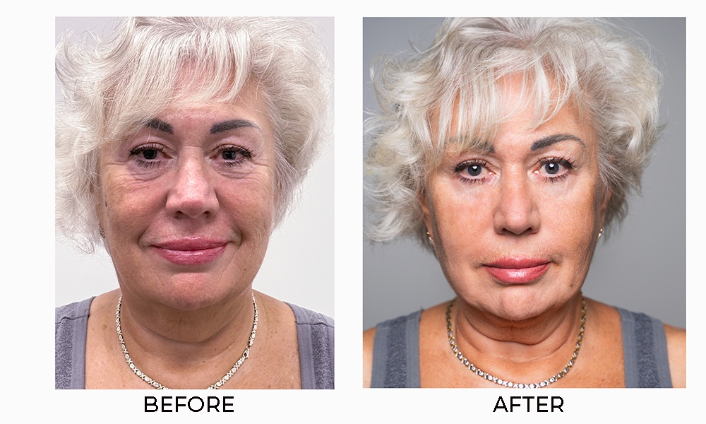 Customer before and after result 1